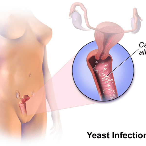 Candidiasis