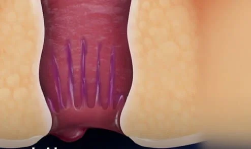 What are hemorrhoids
