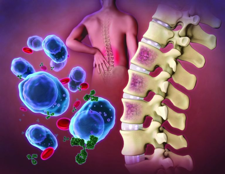 What is multiple myeloma? The disease that allegedly killed John Kumah
