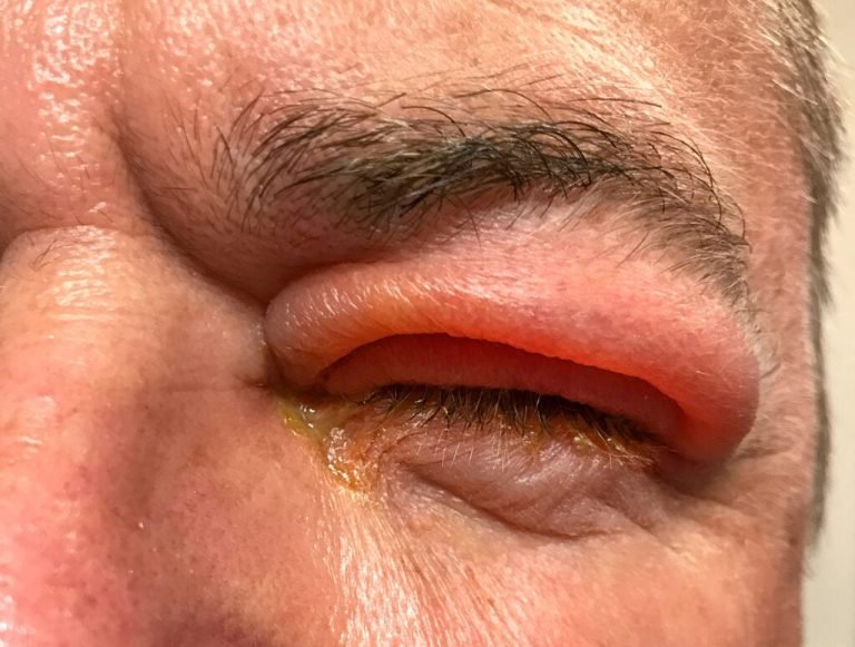 You can contract gonorrhea (gonococcal conjunctivitis) in your eyes if you do these 3 things